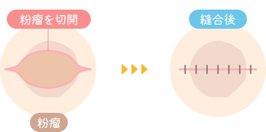 従来の粉瘤手術